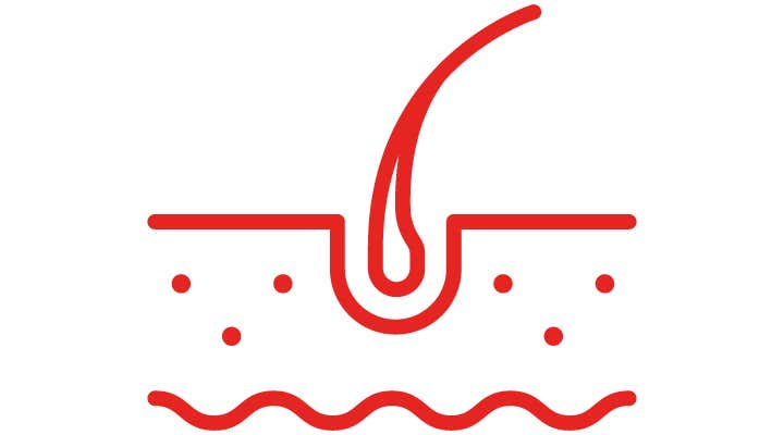 Psoriasis cuero cabelludo