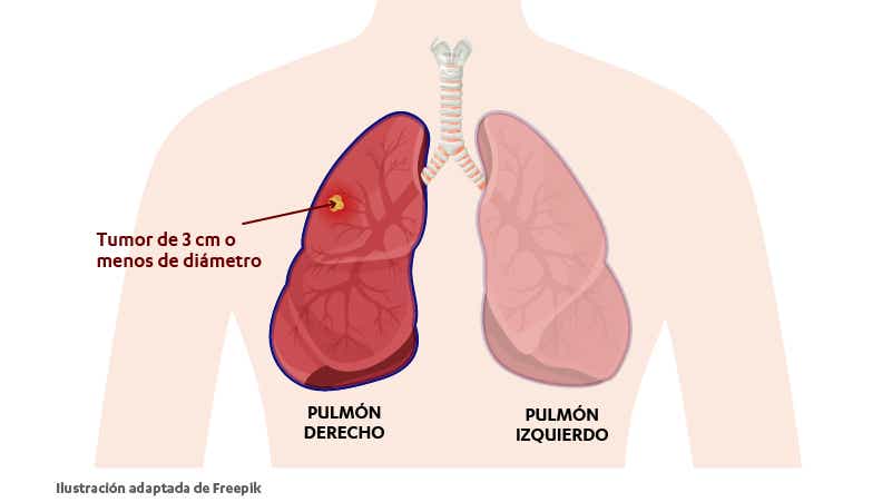 Estadio IA del cáncer de pulmón. Las células cancerosas han sobrepasado el revestimiento más interno del pulmón hasta el tejido pulmonar más profundo.