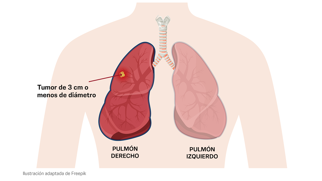 Estadio IA del cáncer de pulmón. Las células cancerosas han sobrepasado el revestimiento más interno del pulmón hasta el tejido pulmonar más profundo.