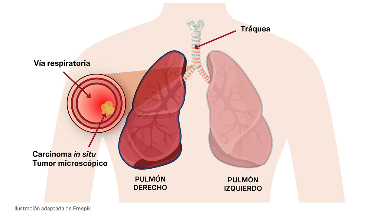 Estadio 0 del cáncer de pulmón