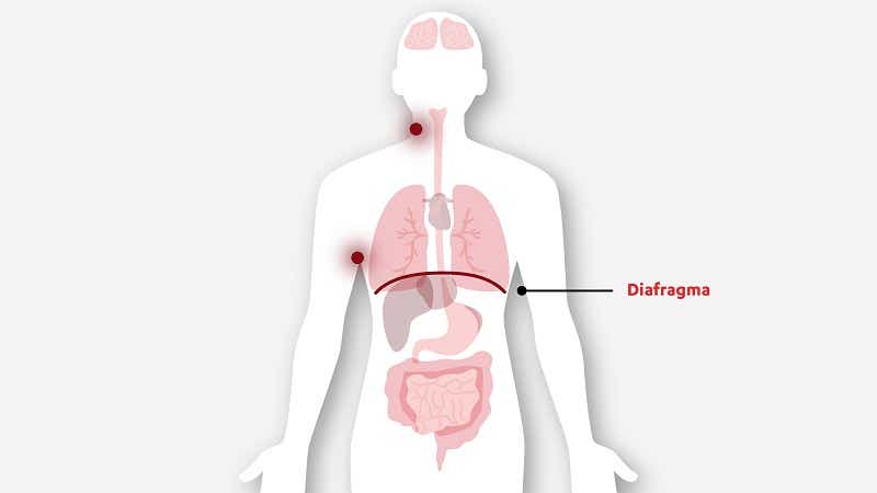 Se llama estadio II cuando el linfoma se localiza en dos o más áreas de ganglios linfáticos en el mismo lado del diafragma
