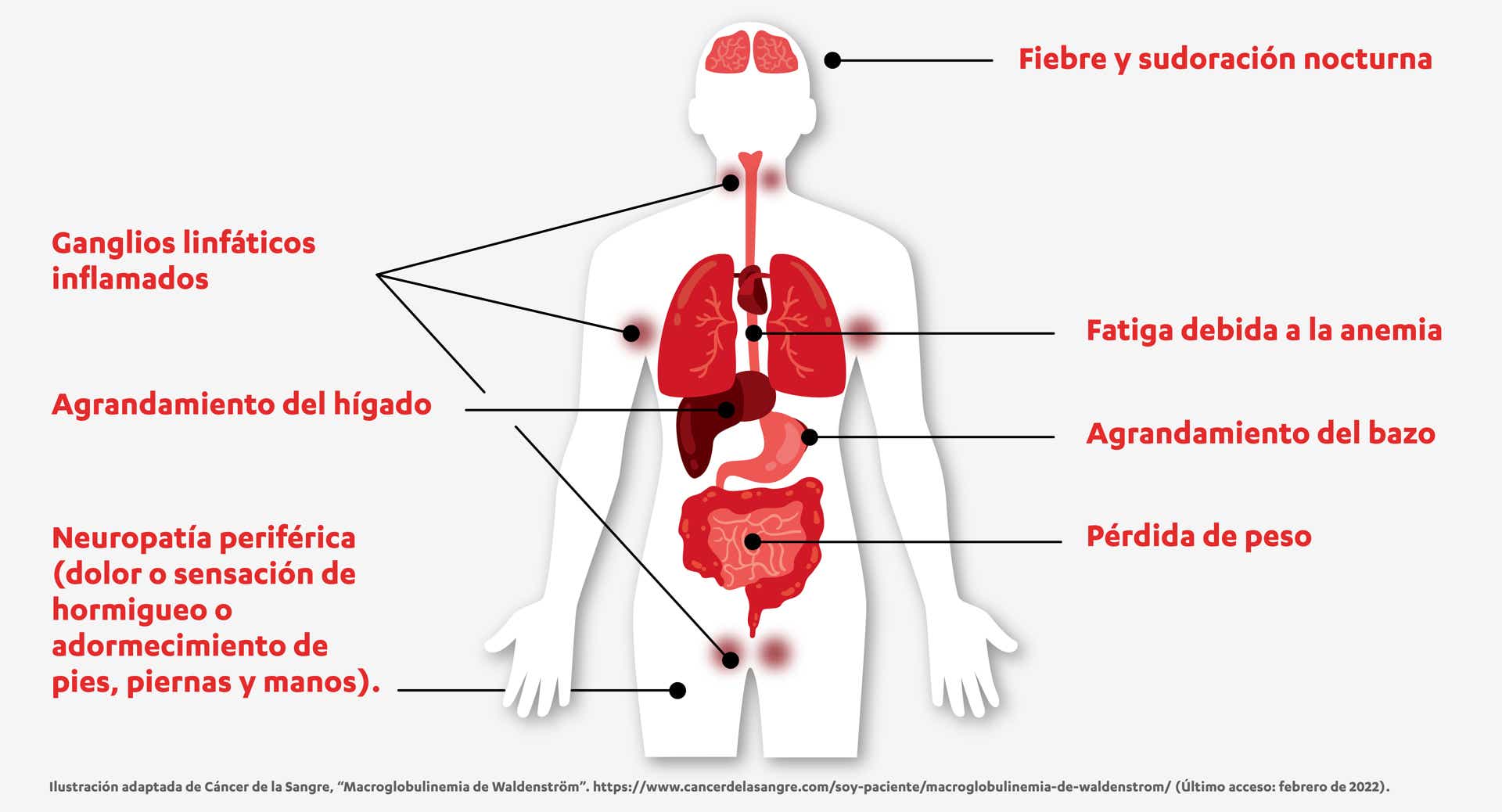 Zonas del cuerpo humano a las que afecta la macroglobulinemia de Waldenström