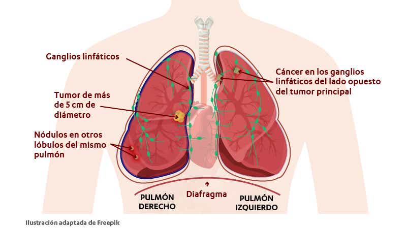 Estadio IIIC del cáncer de pulmón cuando invade estructuras vecinas y se detectan células malignas en los ganglios linfáticos. 