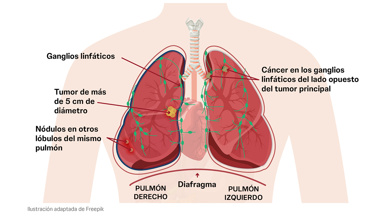 Estadio IIIC del cáncer de pulmón cuando invade estructuras vecinas y se detectan células malignas en los ganglios linfáticos.