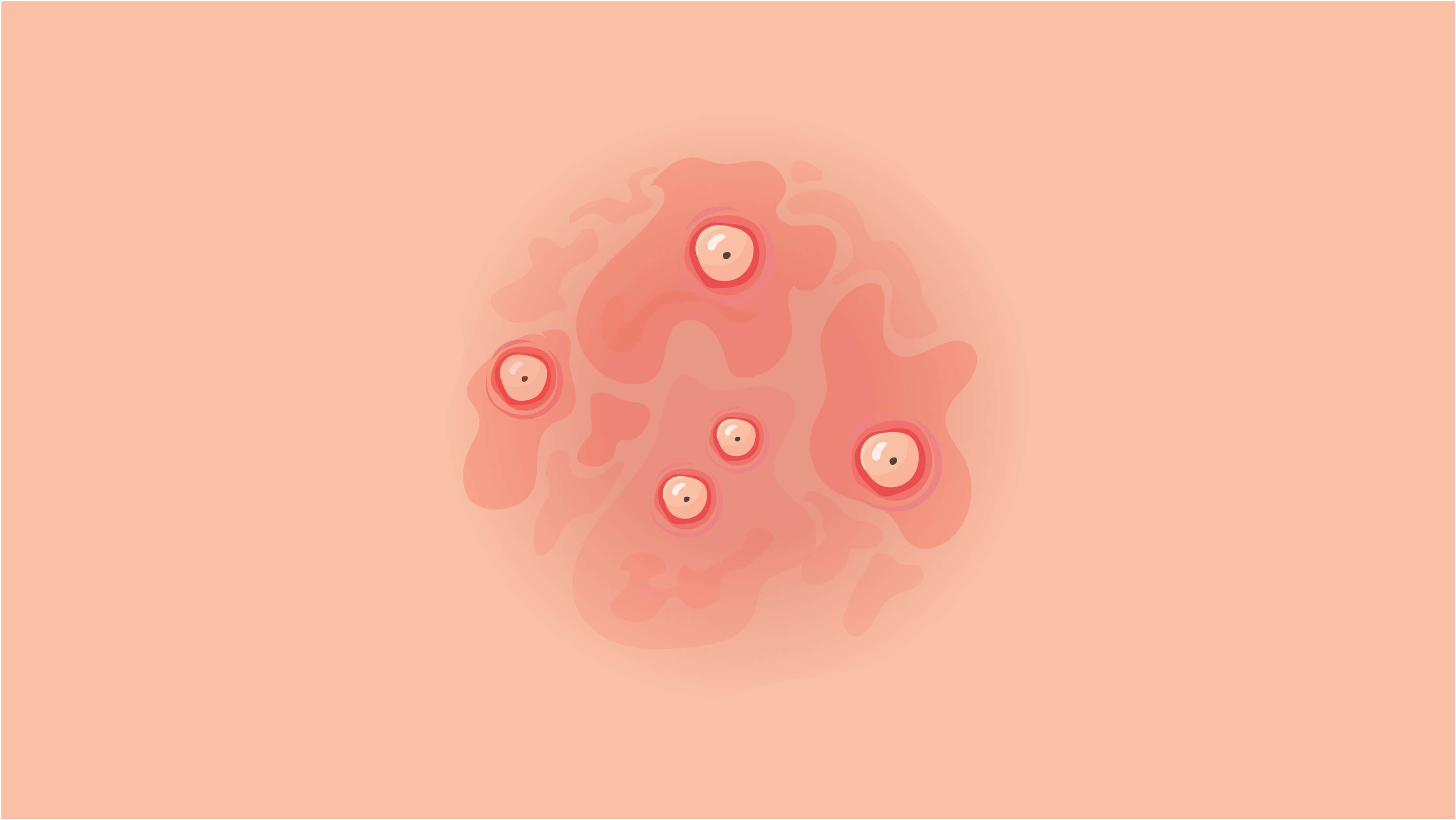 La pustulosa es un tipo poco frecuente de psoriasis