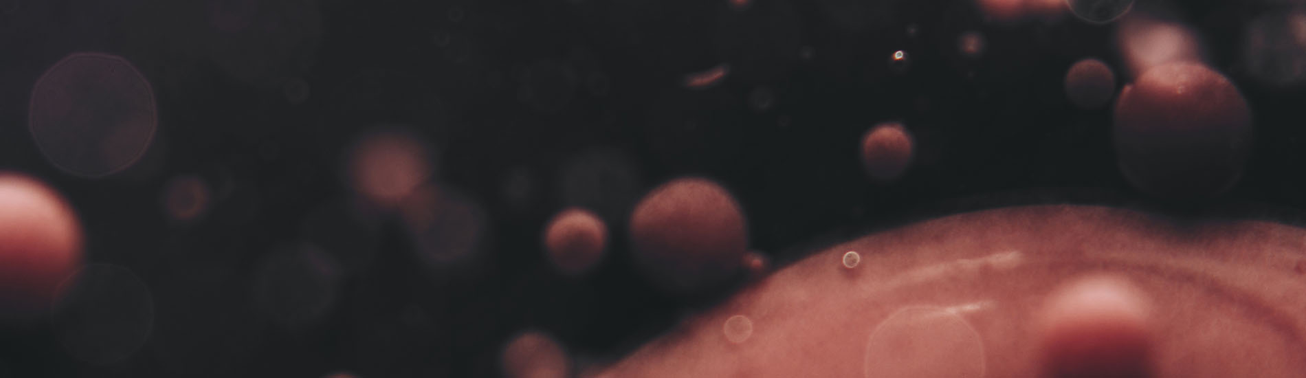 Leucemización del linfoma de células del manto