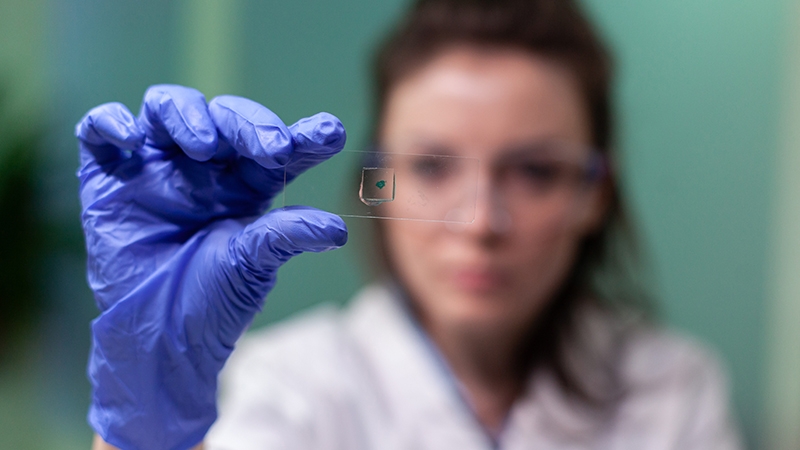 Biomarcadores  para diagnosticar un cáncer de pulmón