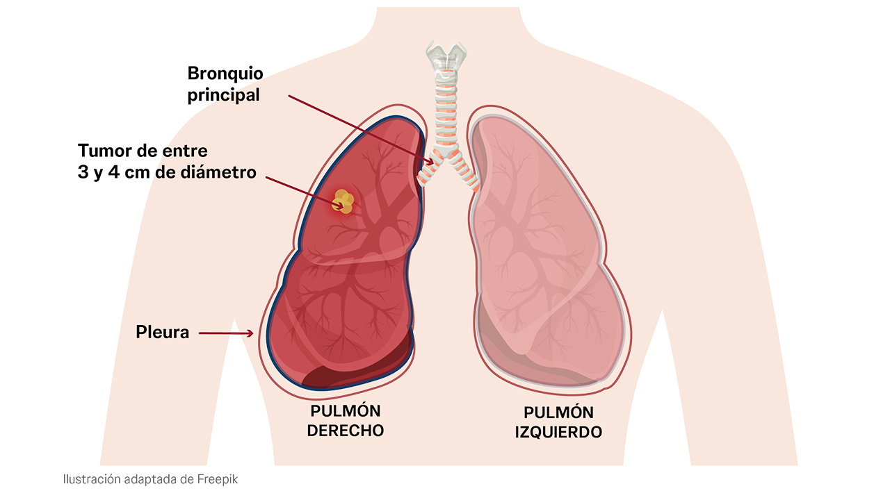 Estadio IB del cáncer de pulmón. El tumor es más grande o ha crecido más en profundidad.