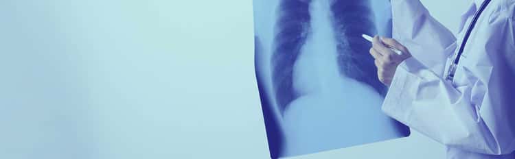 diagnostico-cancer-pulmon Diagnóstico del cáncer de pulmón