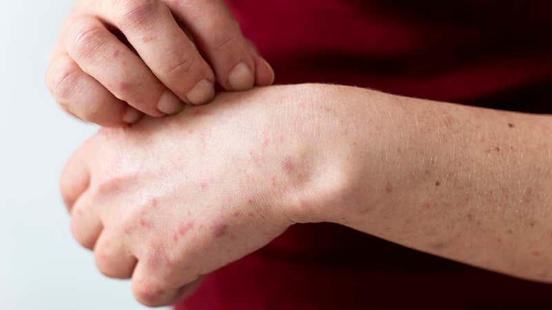 El sentimiento de vergüenza puede ser una repercusión psicosocial de la psoriasis