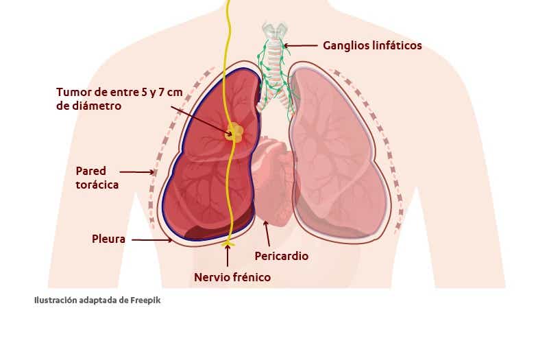 Estadio IIB del cáncer de pulmón. Tumor entre 5 y 7 centímetros o células cancerosas en los ganglios linfáticos.
