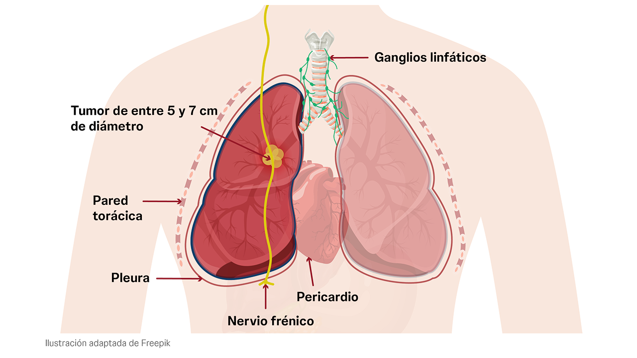 Estadio IIB del cáncer de pulmón. Tumor entre 5 y 7 centímetros o células cancerosas en los ganglios linfáticos.