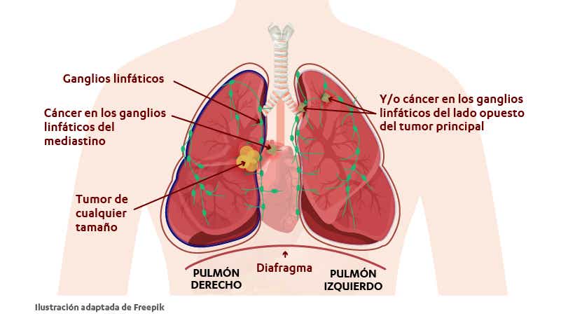 Estadio IIIB del cáncer de pulmón con células malignas en los ganglios linfáticos.