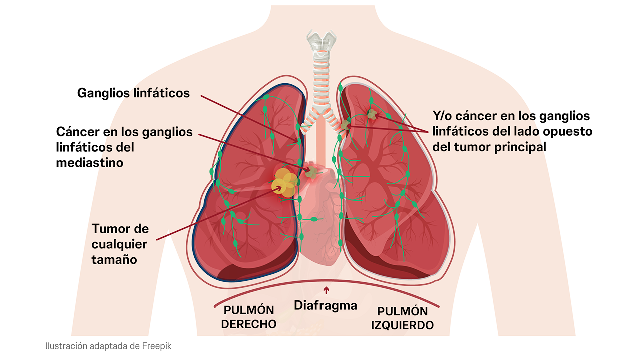 Estadio IIIB del cáncer de pulmón con células malignas en los ganglios linfáticos.
