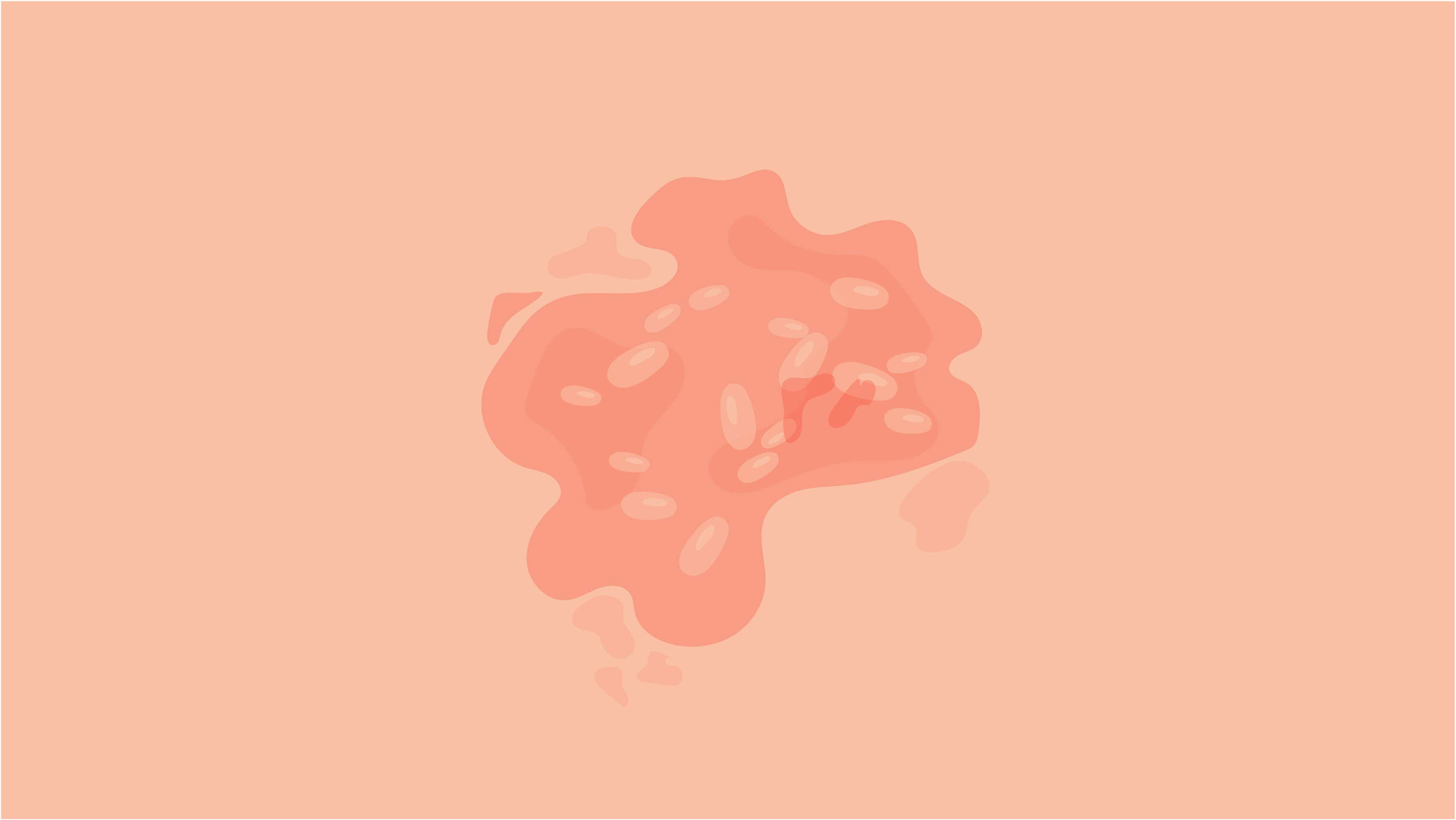 Un tipo grave de psoriasis es la eritrodérmica