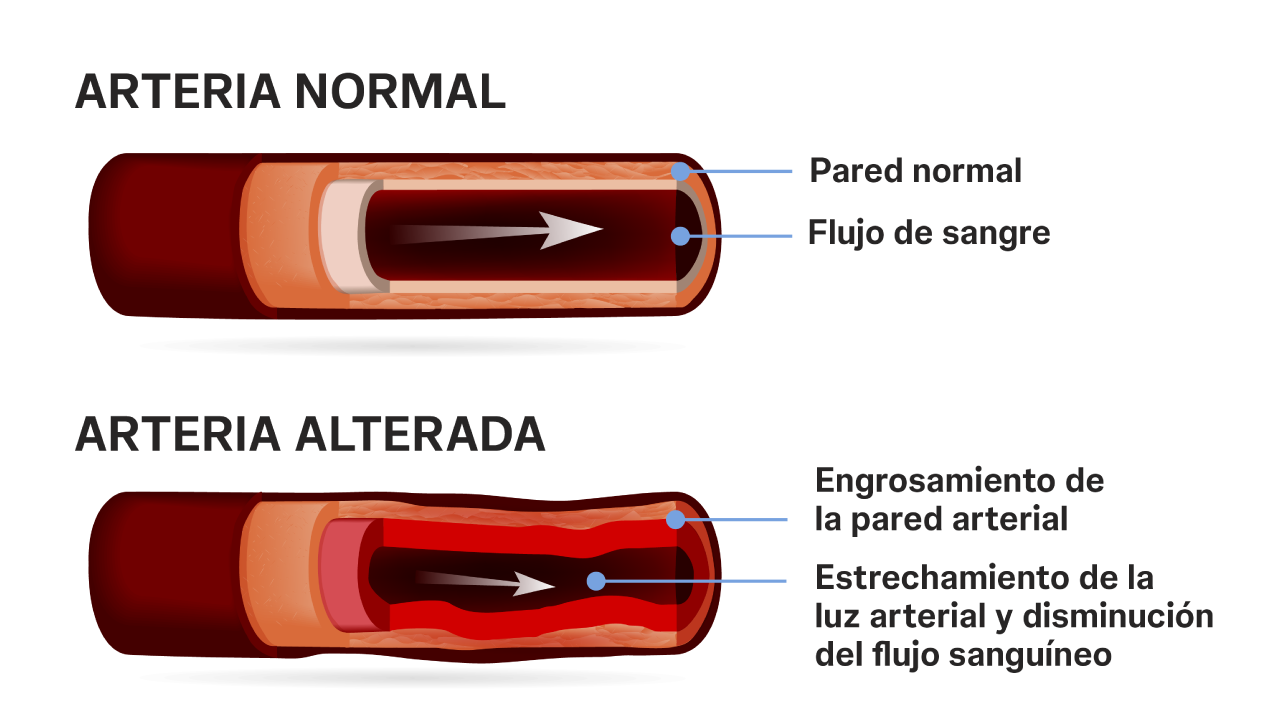 Existen otros cuatro grupos de hipertensión arterial además de la hipertensión arterial pulmonar