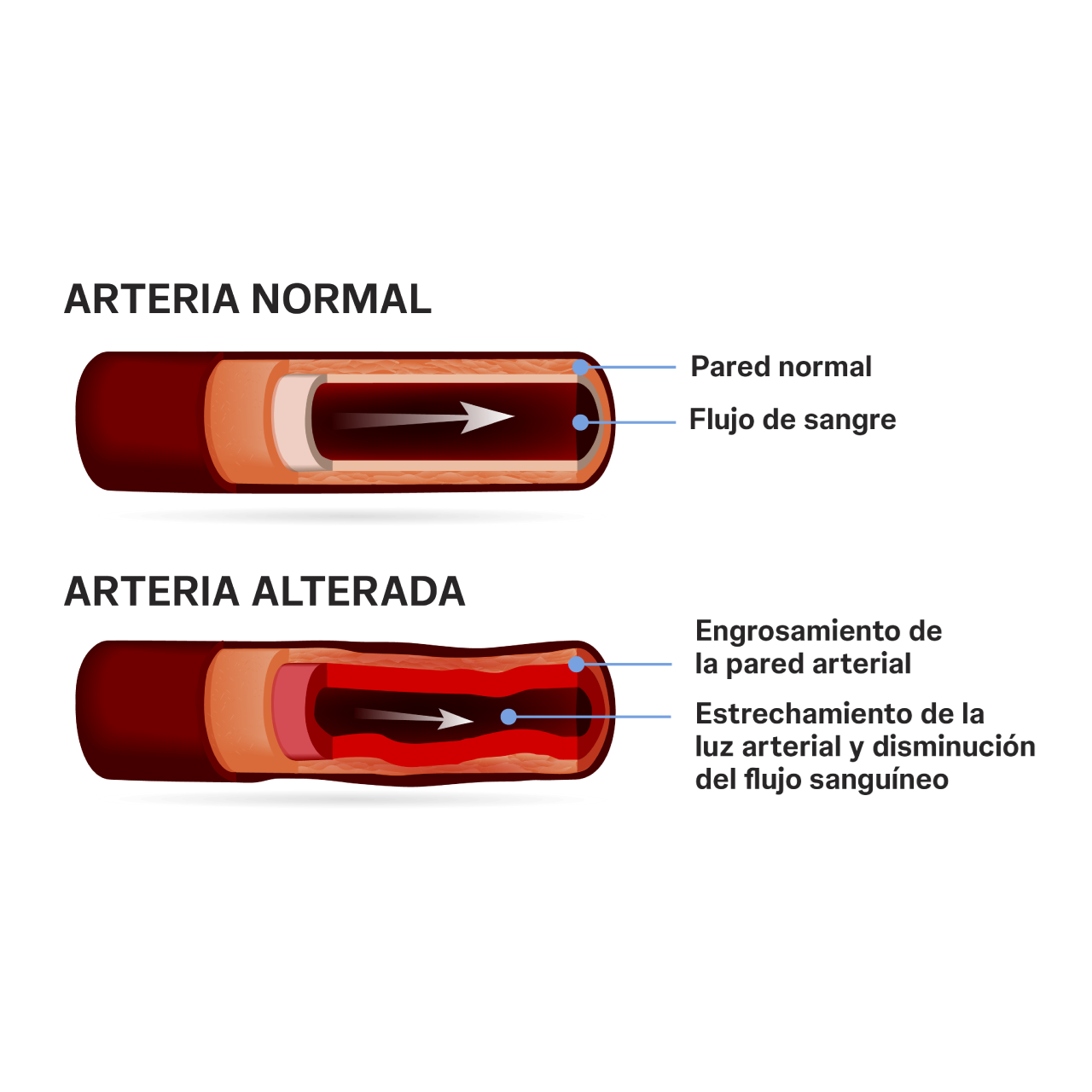 Existen otros cuatro grupos de hipertensión arterial además de la hipertensión arterial pulmonar