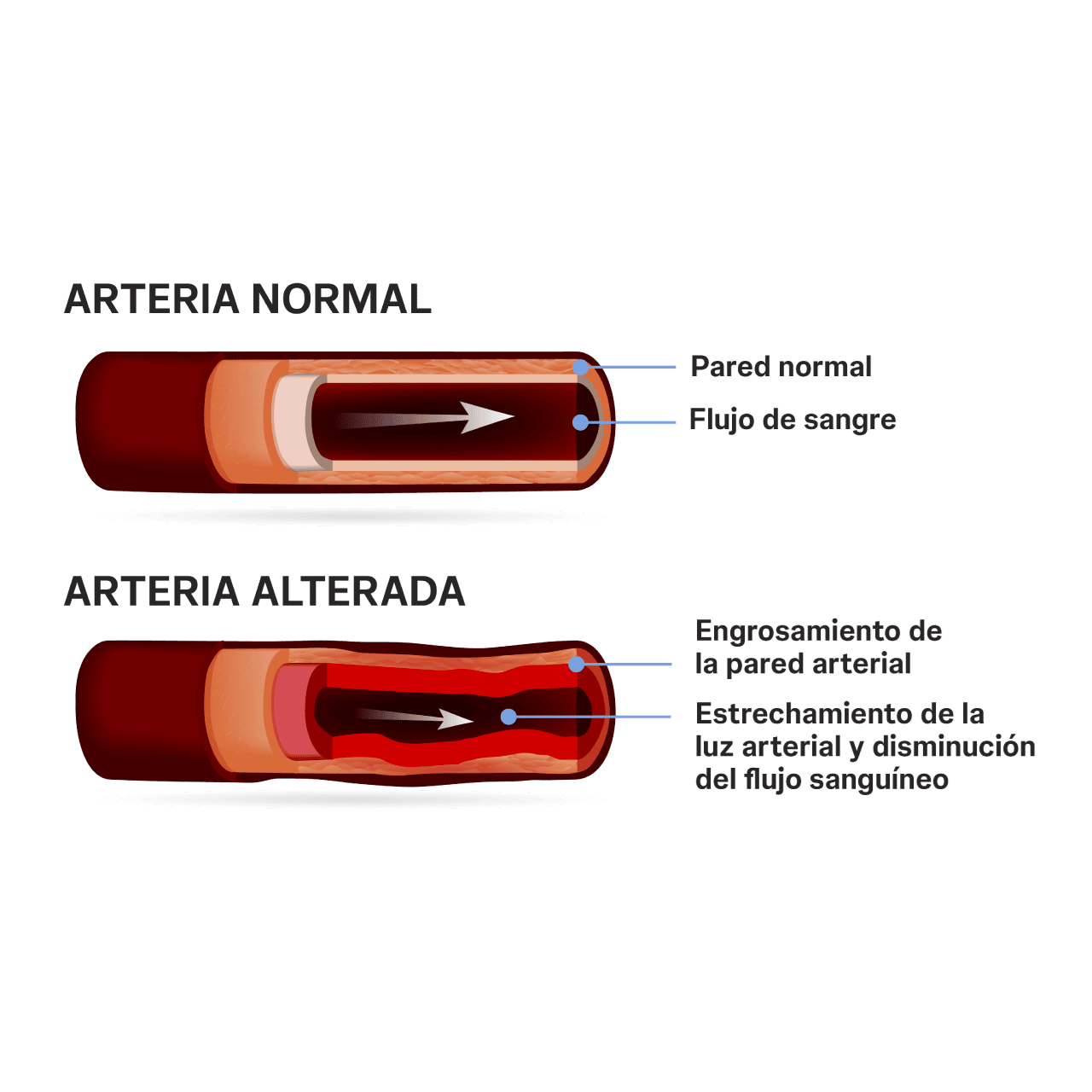 Existen otros cuatro grupos de hipertensión arterial además de la hipertensión arterial pulmonar