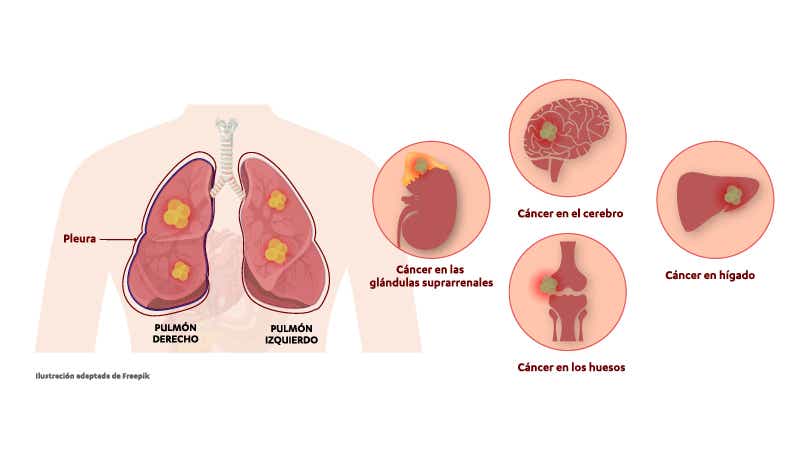 Estadio IV del cáncer de pulmón cuando la enfermedad se encuentra en fase metastásica.  