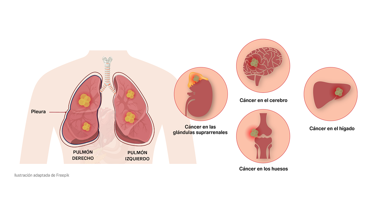 Estadio IV del cáncer de pulmón cuando la enfermedad se encuentra en fase metastásica.  