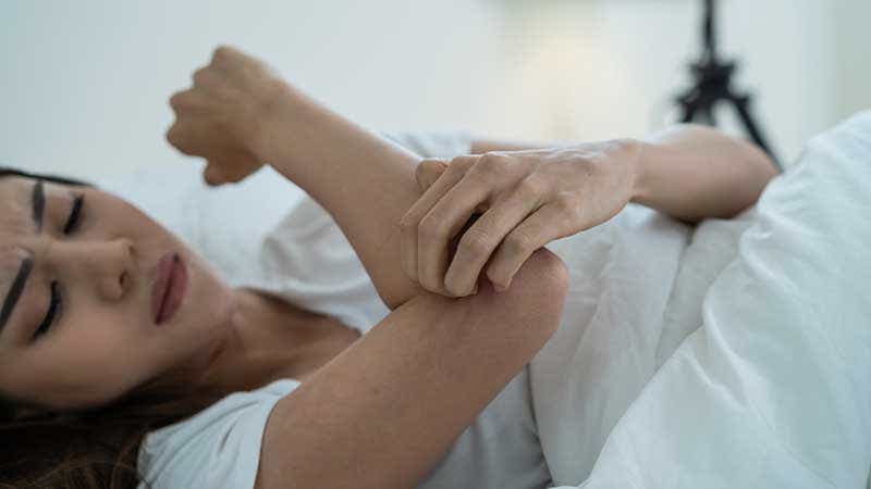 Mitos de la psoriasis: paciente con psoriasis en un brazo