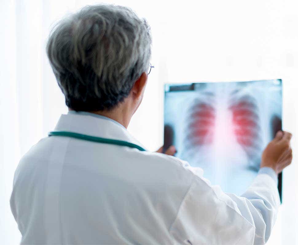 Medico revisando radiografía para ver estadios avanzados del cáncer de pulmón. 