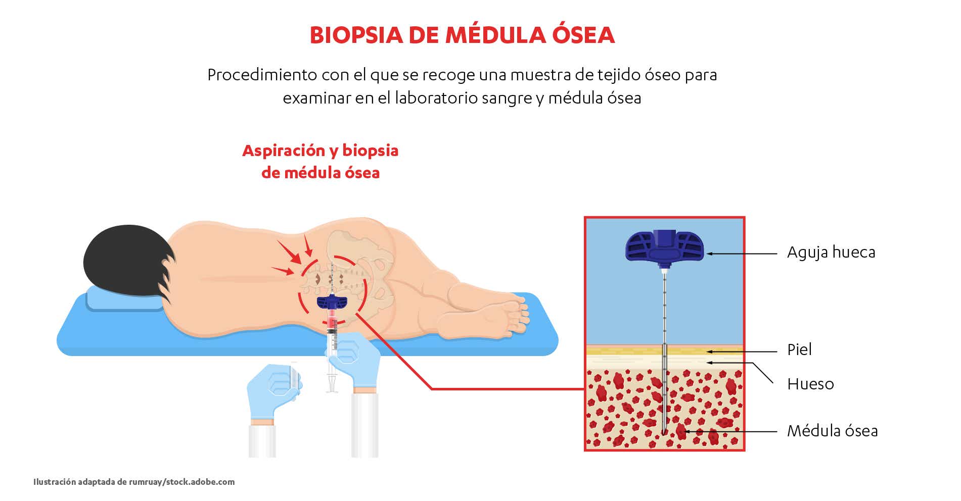 Procedimiento en el que se recoge una muestra de tejido óseo para examinar en el laboratorio sangre y médula ósea