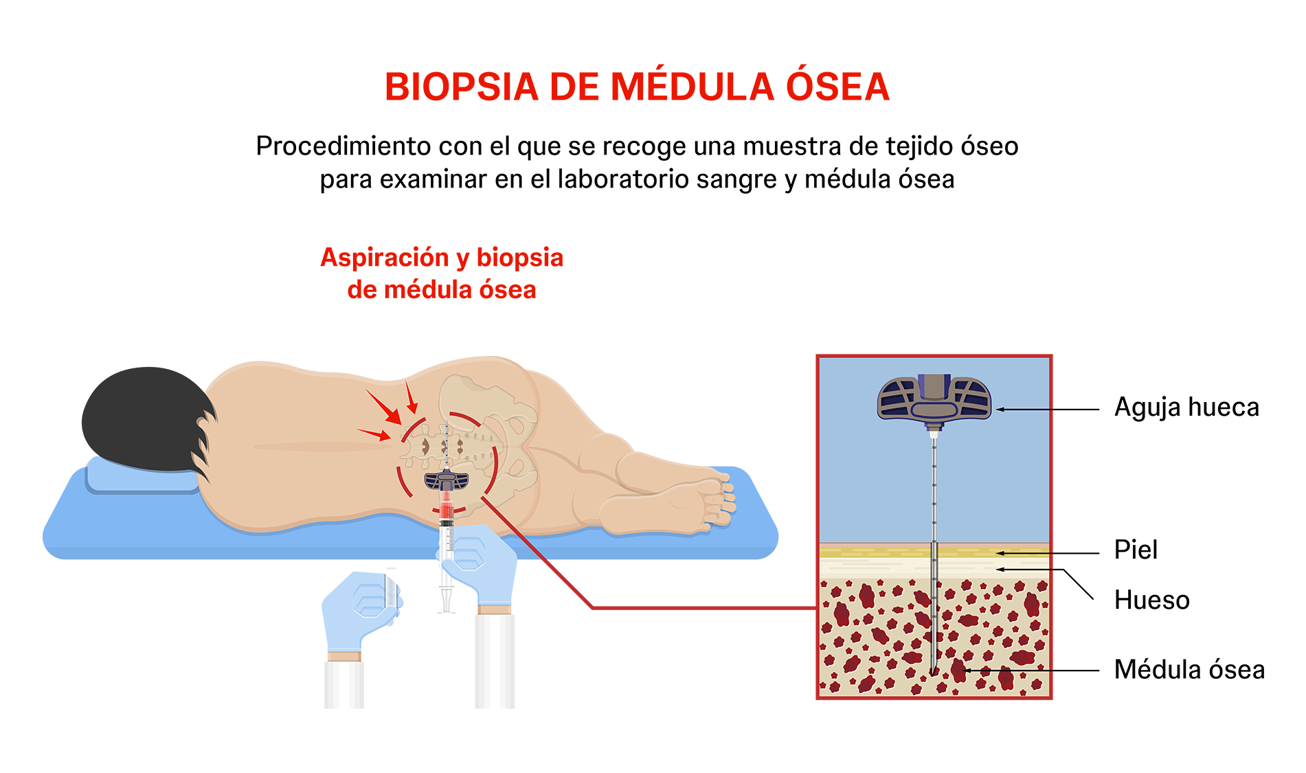 Aspiración médula Procedimiento en el que se recoge una muestra de tejido óseo para examinar en el laboratorio sangre y médula ósea