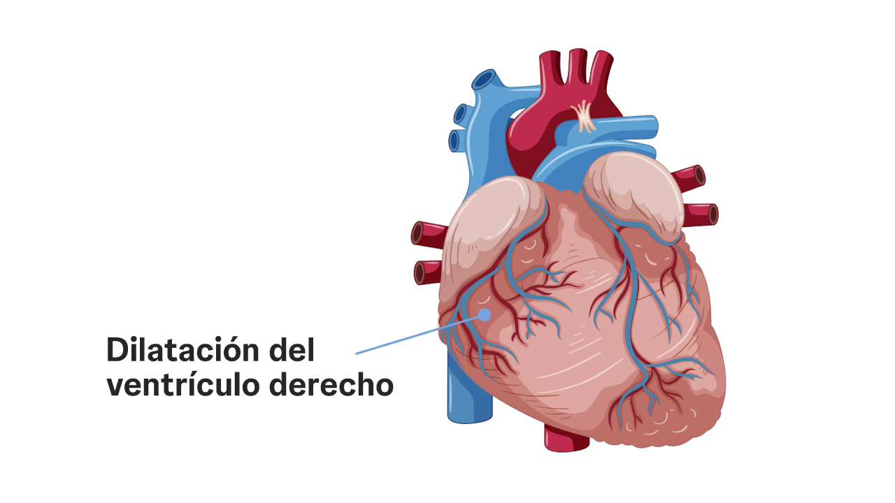 La alta presión en la hipertensión arterial pulmonar tiene repercusión en el corazón