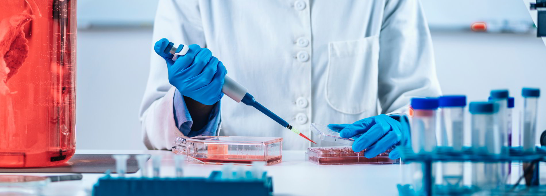 Recaídas en la macroglobulinemia de Waldenström