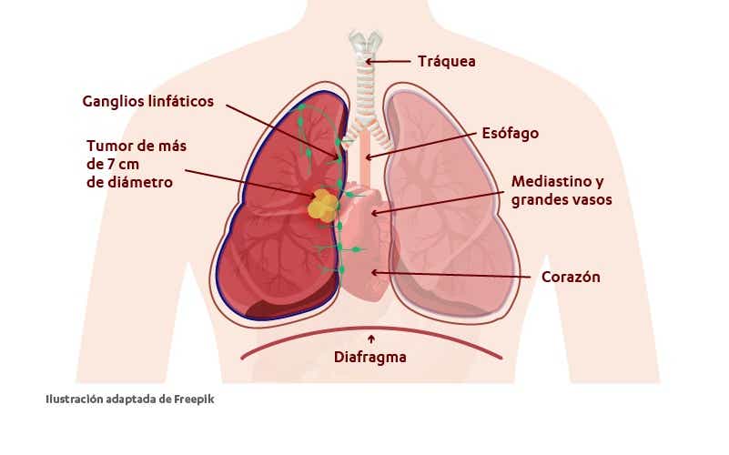 Estadio IIIA del cáncer de pulmón cuando la enfermedad está en una fase localmente avanzada. 