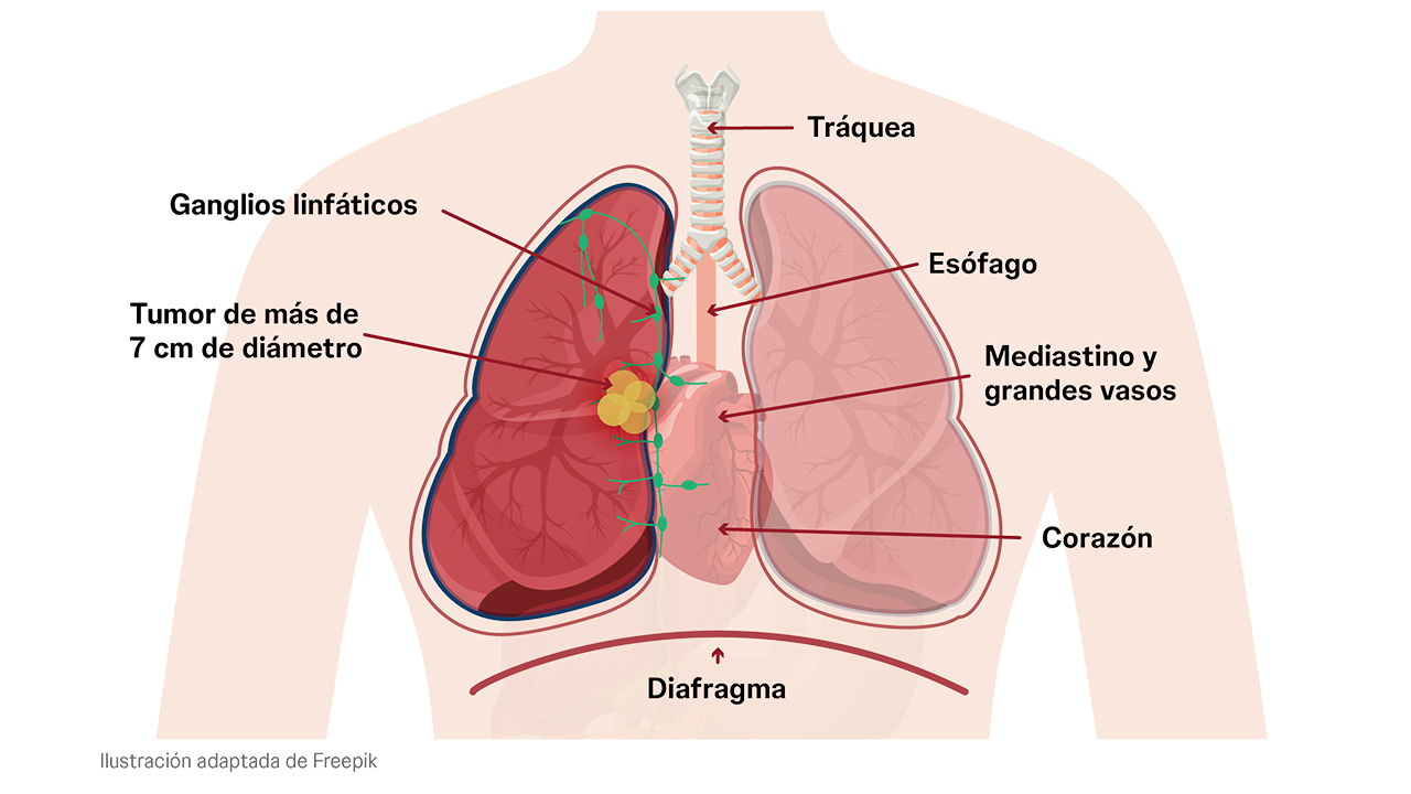 Estadio IIIA del cáncer de pulmón cuando la enfermedad está en una fase localmente avanzada.
