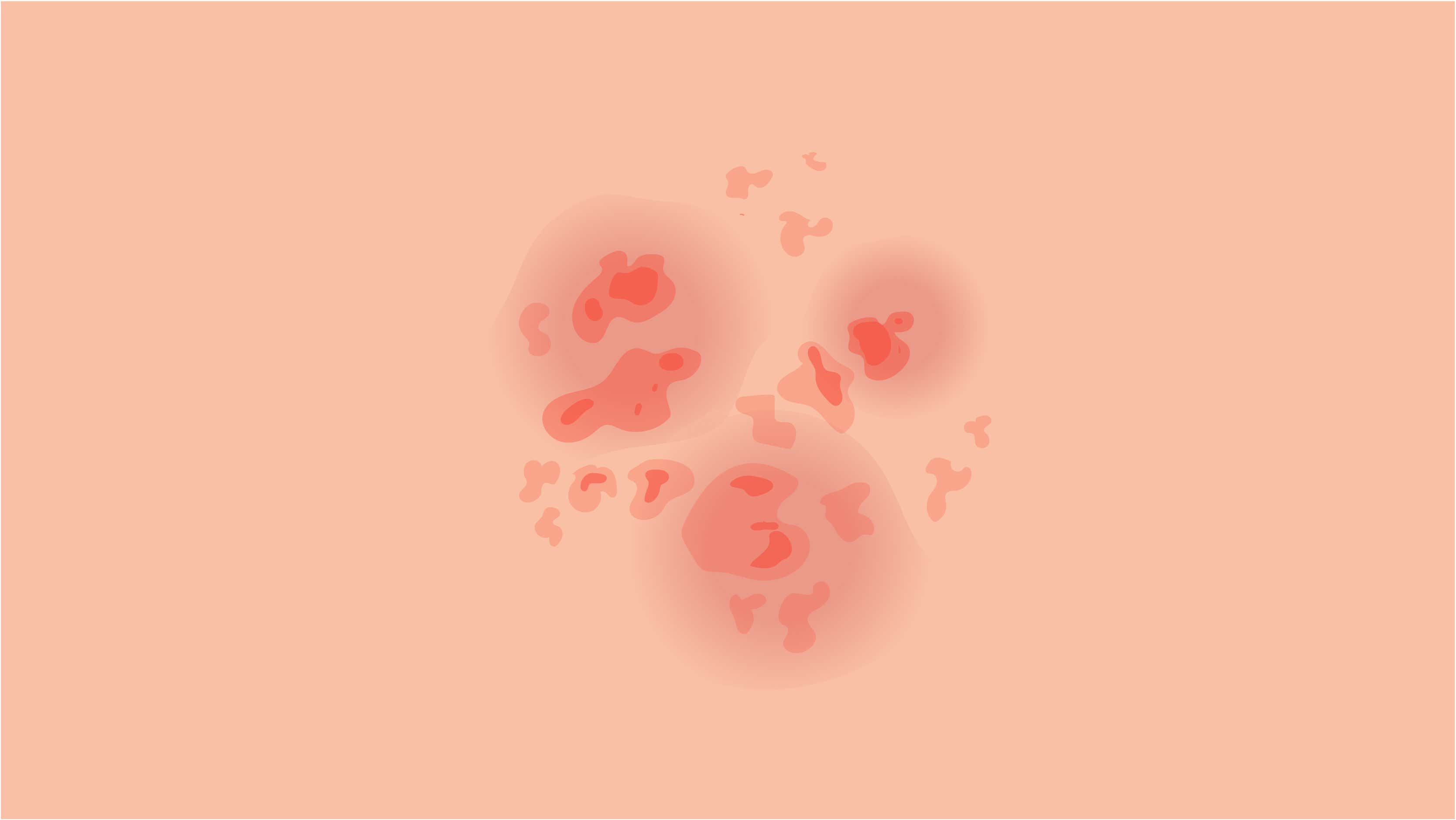 La psoriasis en gotas suele aparecer en niños y adolescentes