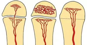 Painful hip figure 1.jpg Painful hip figure 1.jpg