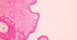 Mammography images Mammography images