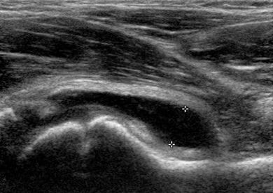 Painful_hip_figure_3.jpg Painful_hip_figure_3.jpg