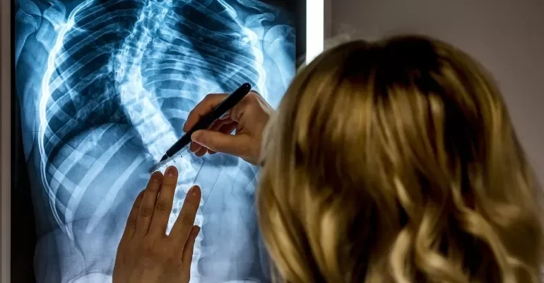 scoliosis scoliosis