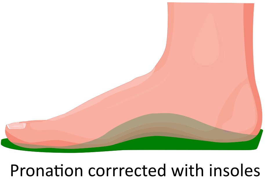 PronationSideCorrected.jpg
