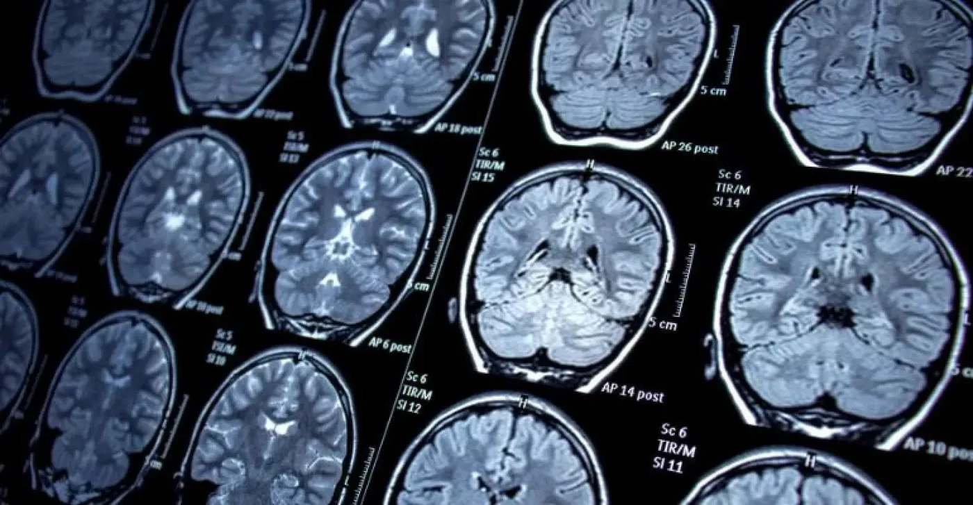 epilepsy epilepsy