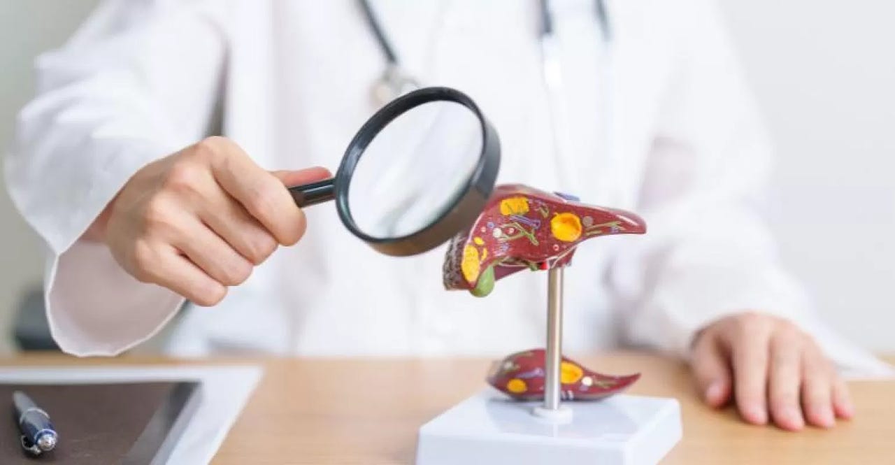 liver fibrosis.jpg liver fibrosis.jpg