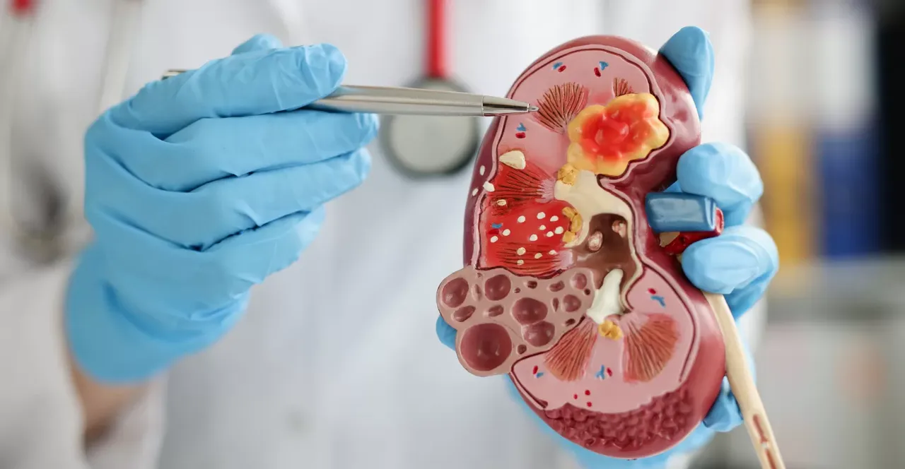 World Kidney Day World Kidney Day