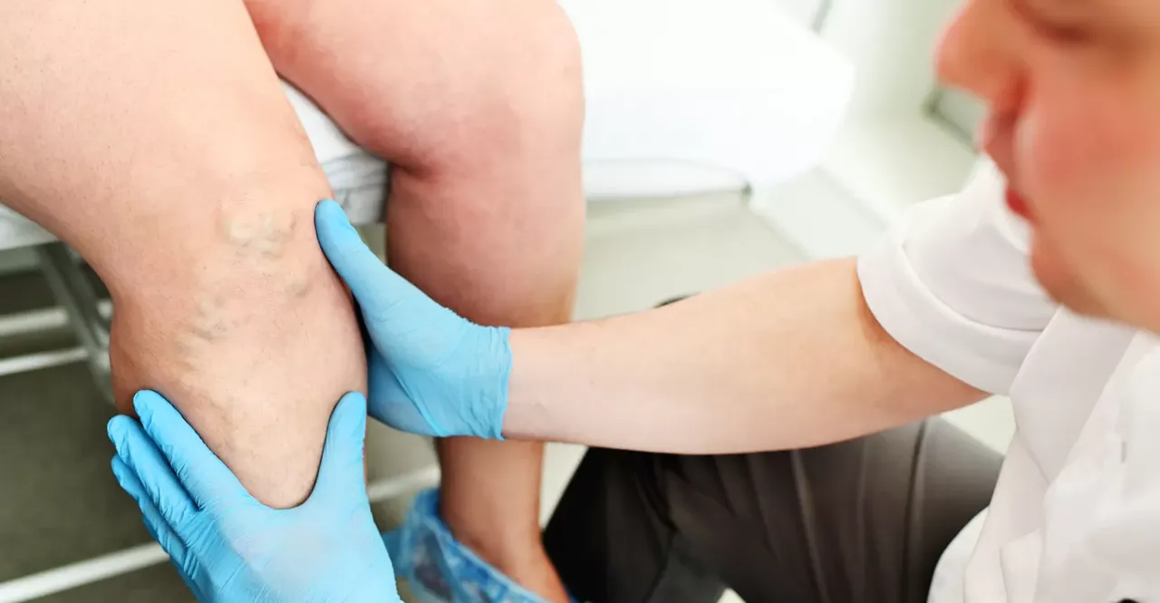 vein thrombosis vein thrombosis