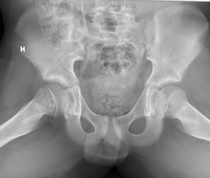 Painful_hip_figure_5.jpg Painful_hip_figure_5.jpg