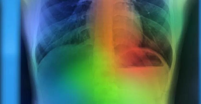 Radiology imaging of a chest Radiology imaging of a chest