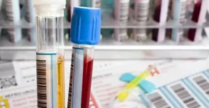 coaguation.jpg coaguation.jpg