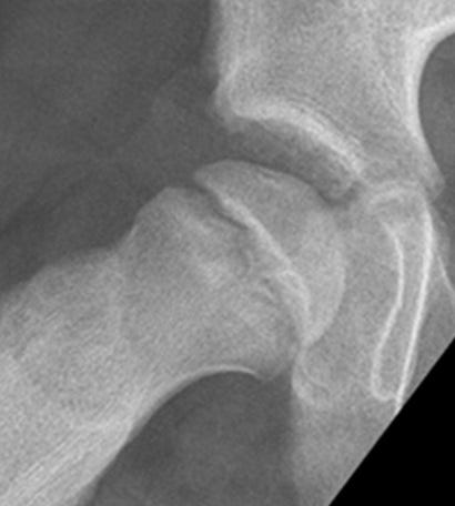 Painful_hip_figure_4.jpg Painful_hip_figure_4.jpg