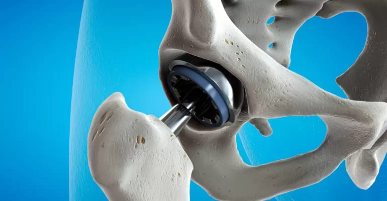 hip implant.png hip implant.png