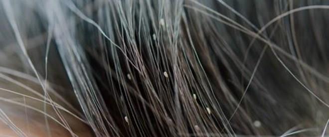 Como quitar las liendres