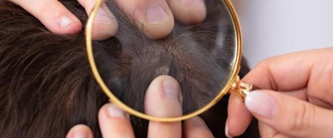 De que color son las liendres de los piojos