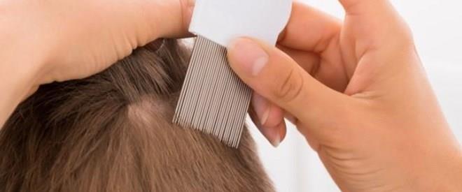 Como diferenciar las liendres de la caspa